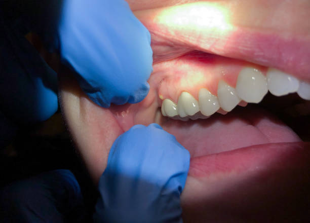 Best Emergency Root Canal Treatment in Marysville, MI