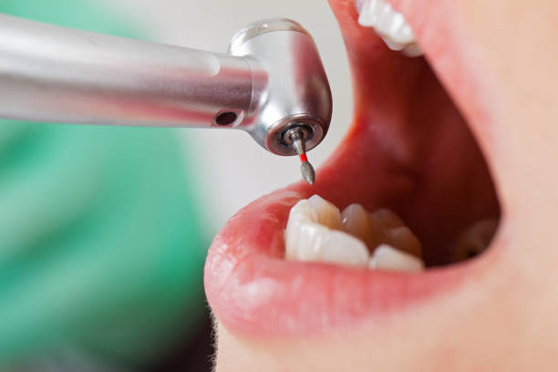 Best Emergency Treatment for Dental Infections or Abscesses in Marysville, MI